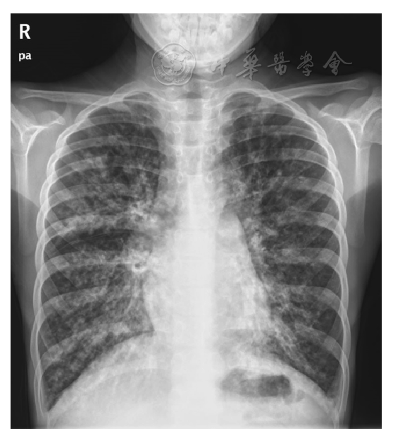 儿童囊性肺纤维化合并重症肺炎一例