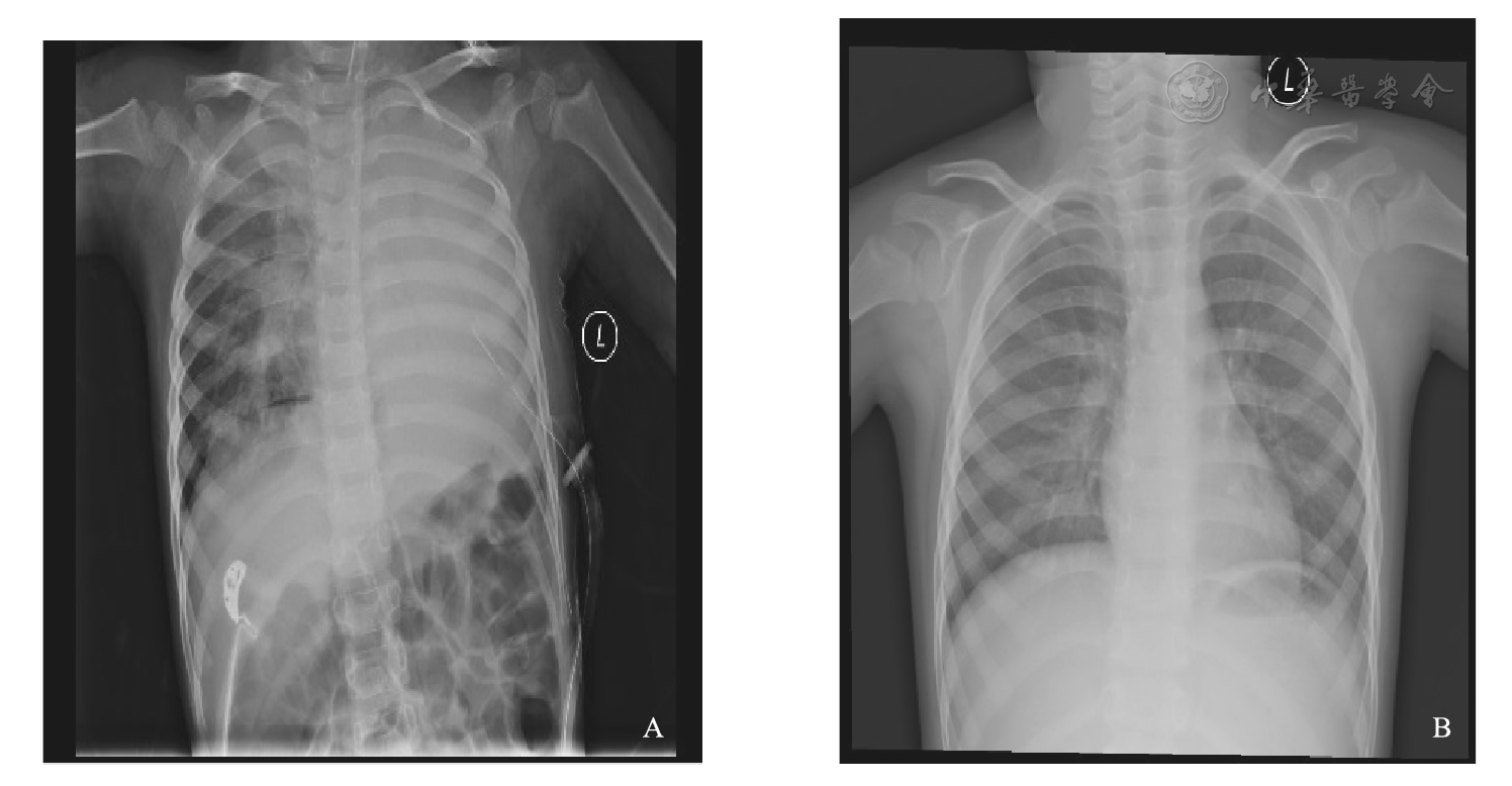 小儿重症甲型h1n1流感合并塑型性支气管炎四例分析并文献复习