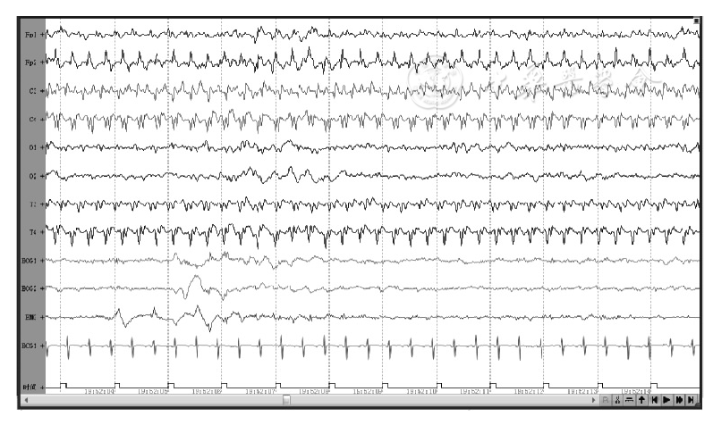 视频脑电图监测在新生儿惊厥发作中的作用分析
