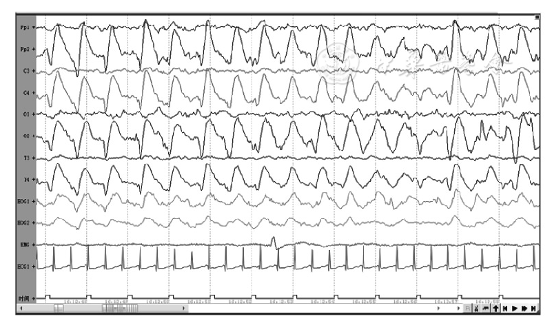 视频脑电图监测在新生儿惊厥发作中的作用分析