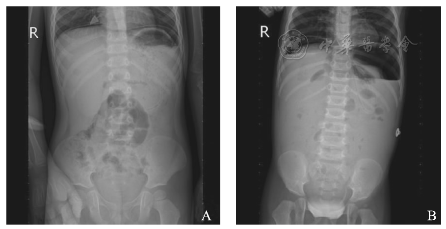 大量液气腹     两例患儿术前的x线腹平片检查影像