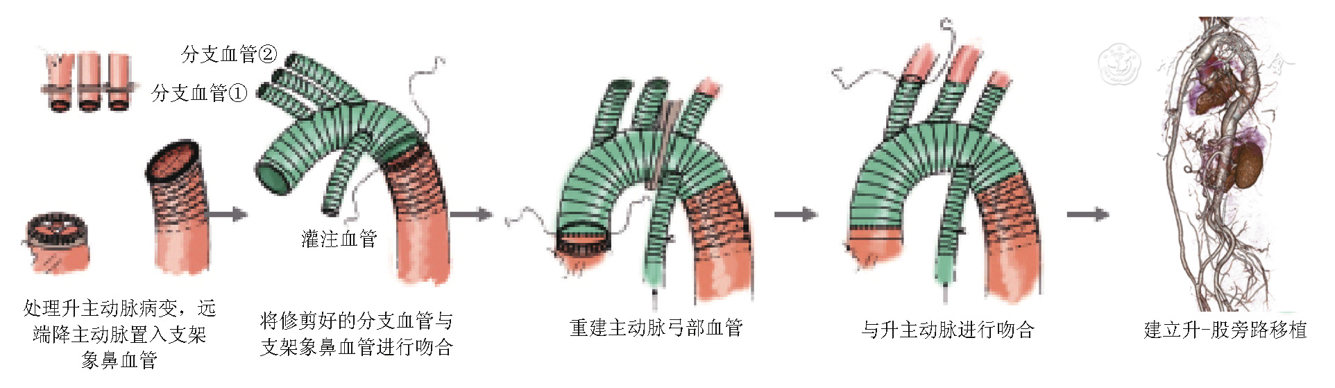 探讨孙氏手术基础上加用升主动脉-股动脉旁路移植术治疗复杂型