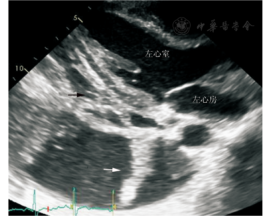 胸腔积液和压缩的肺叶(白色箭头所示 患者超声心动图