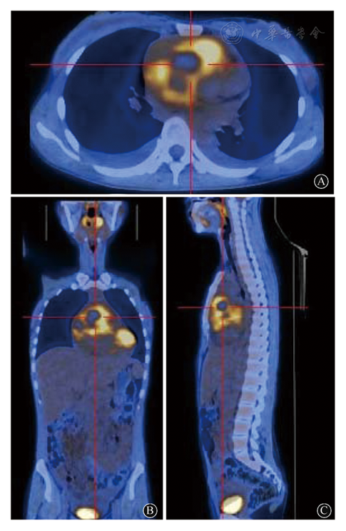 a:横面;b:冠状面;c:矢状面;红色十字中心所示心脏肿瘤呈放射性核素