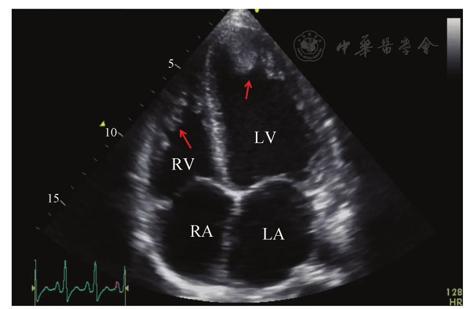 点击查看大图 图1 患者治疗前超声心动图(心尖四腔心切面)