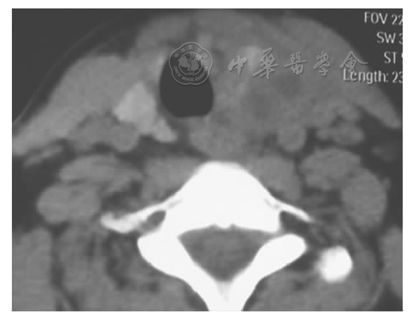 累及甲状腺,病变向上达梨状窝水平,左侧梨状窝周围软组织增厚肿胀并