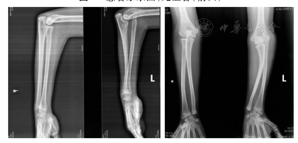 图3 患者Ⅲ6双侧肘关节及尺桡骨正侧位x线片:左侧尺骨干扭曲,上下尺