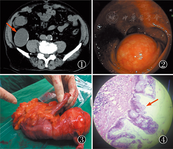 巨大阑尾低级别黏液性肿瘤一例