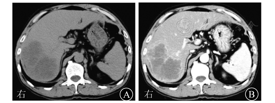 动脉期明显不均匀强化 肝肉瘤样癌患者肝脏ct表现