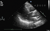 主动脉瓣乳头状弹力纤维瘤超声表现1例