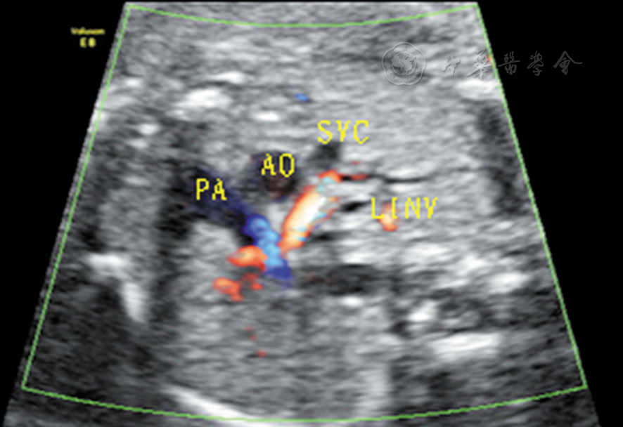 胎儿左无名静脉异常超声表现1例