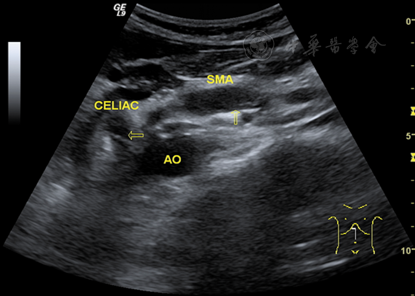 孤立性腹腔干并肠系膜上动脉夹层超声表现1例