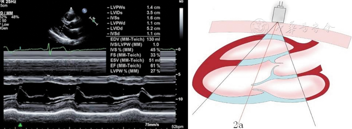 中国成年人超声心动图检查测量指南