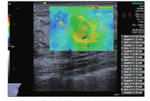 乳腺纤维瘤病超声表现1例 中华超声影像学杂志
