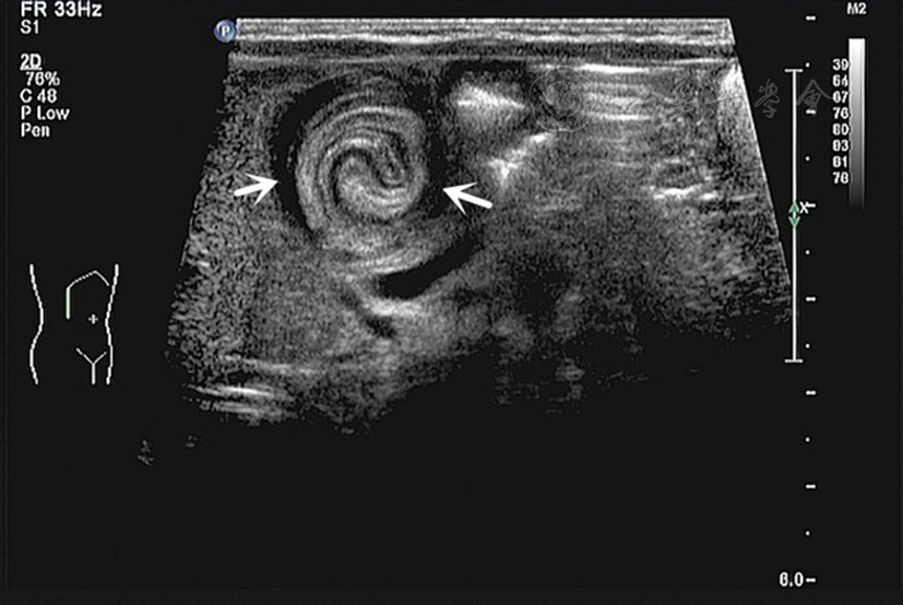 超声诊断新生儿幽门窦息肉伴十二指肠套叠1例