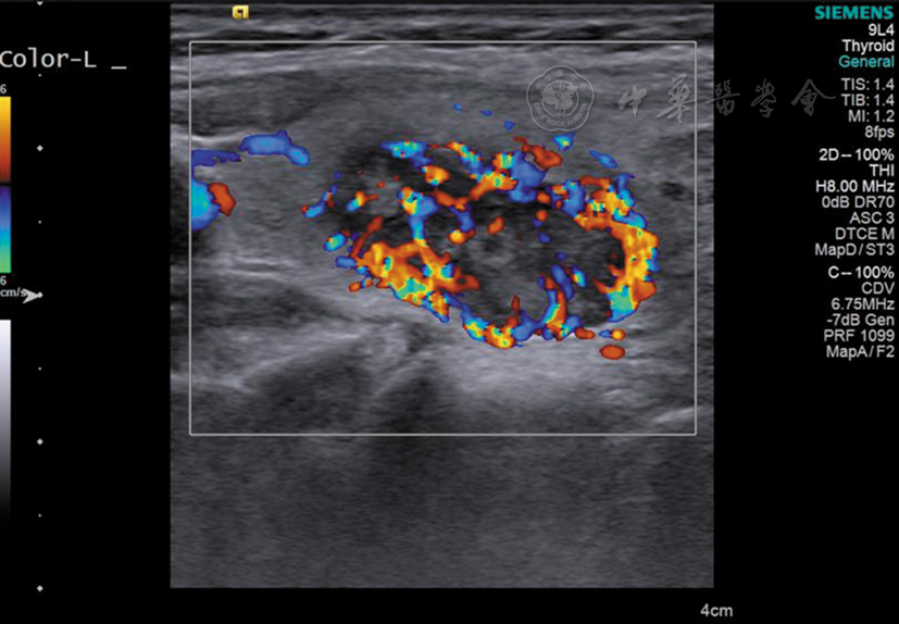 甲状腺内异位甲状旁腺腺瘤超声误诊1例