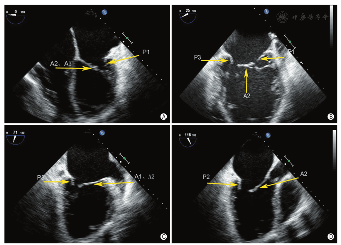 二尖瓣反流介入治疗的超声心动图评价中国专家共识