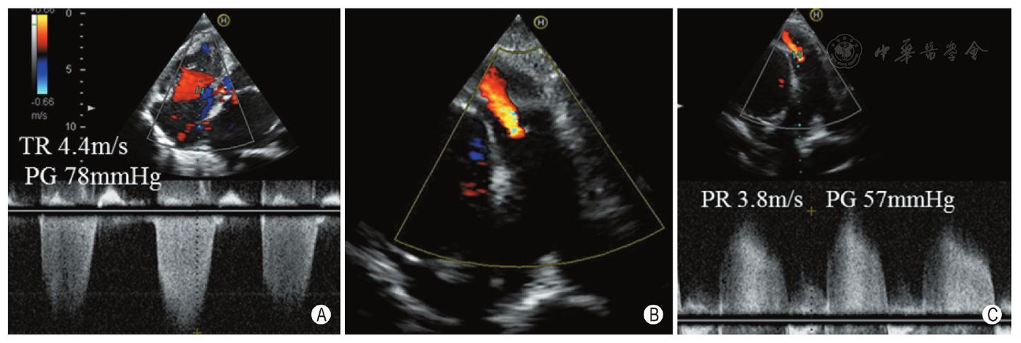 图28 肺动脉高压典型多普勒超声表现 a:三尖瓣收缩期最大峰值流速估