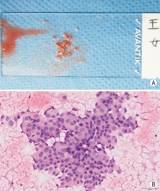 超声引导下甲状腺结节细针穿刺细胞学检查实践指南(2019版)