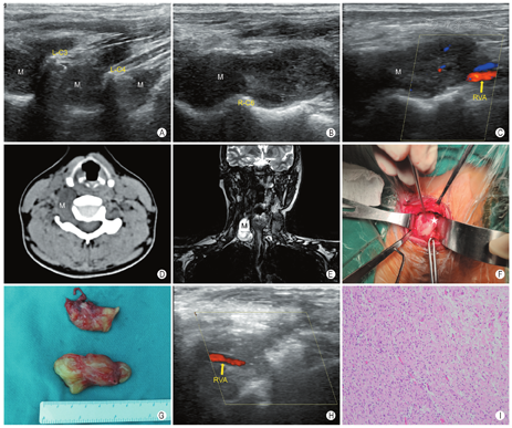颈部神经鞘瘤病超声表现1例