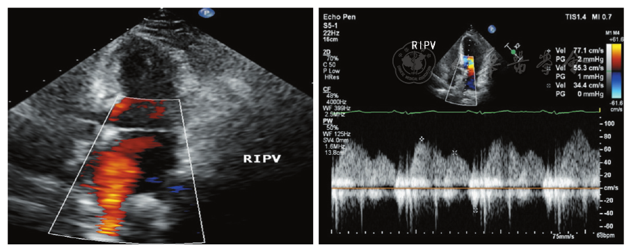 图2 常规经胸超声心动图显示右下肺静脉血流和血流频谱图像(ripv:右下