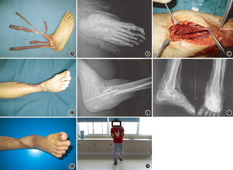 多学科合作救治多发伤合并踝关节离断一例