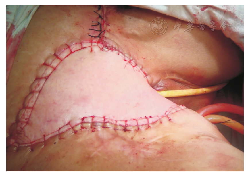 菱形皮瓣和股前外侧皮瓣修复外阴癌术后缺损