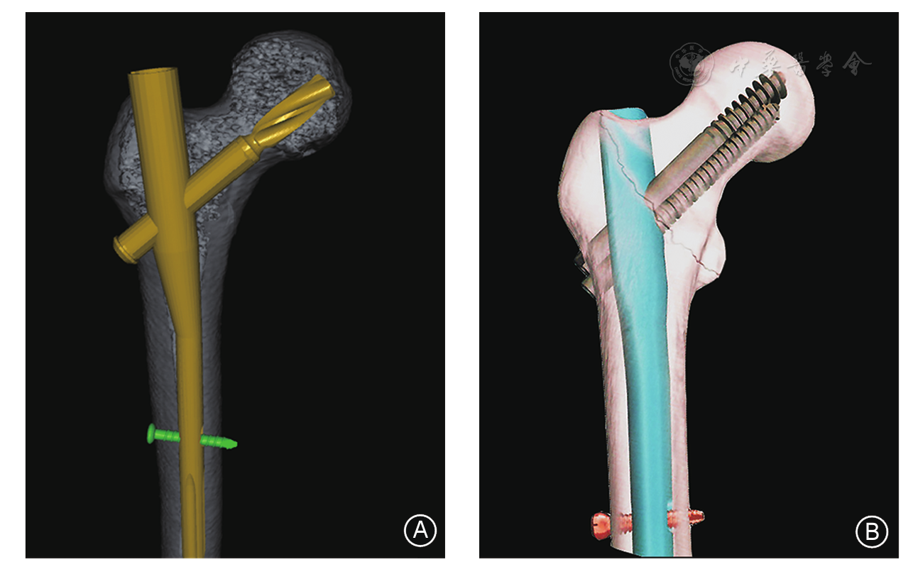图6 股骨转子间骨折的髓内固定系统 a 股骨近端防螺旋髓内钉(pfna)