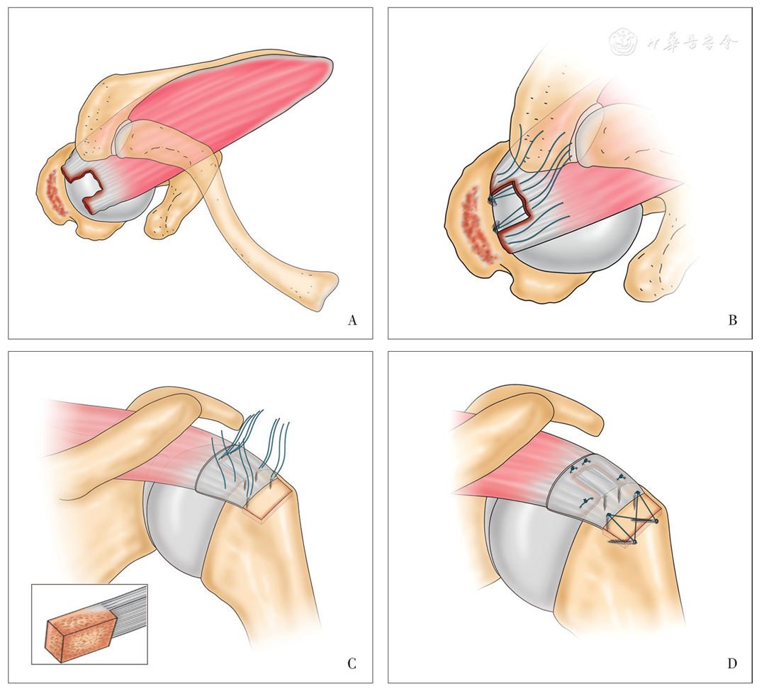原解剖足印区 b 肱骨头软骨边缘植入两枚带线锚钉,缝线依次穿过冈上肌