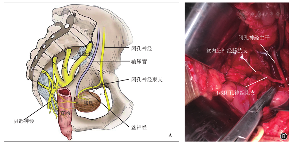 闭孔神经移位修复盆内脏神经治疗创伤性骶丛损伤致排尿障碍