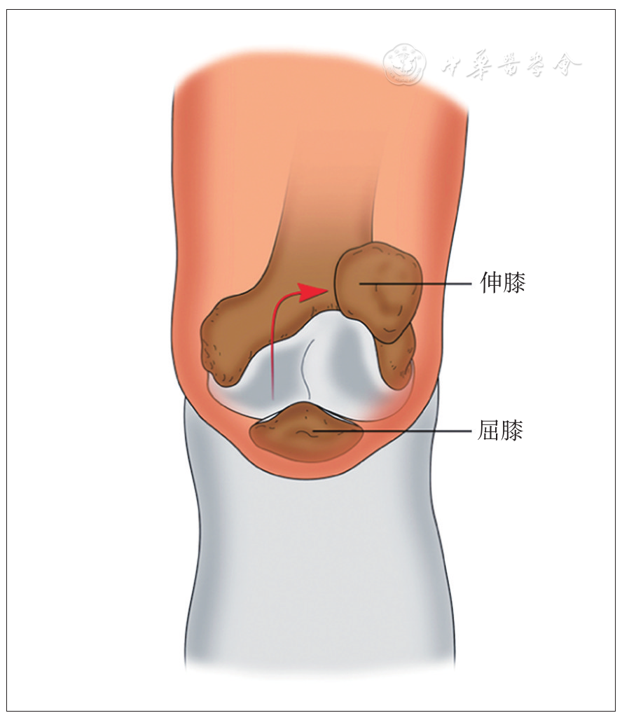 成人复发性髌骨脱位术后膝关节j形征阳性对内侧髌股韧带松弛度的影响