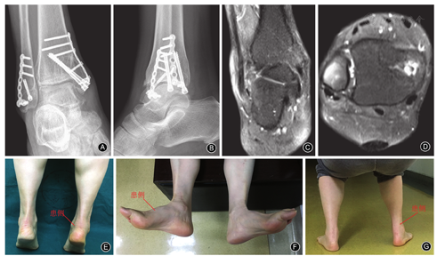 踝关节骨折合并腓骨短肌腱断裂一例报告