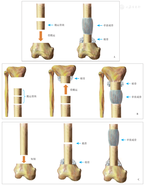 点击查看大图 图7 骨搬运手术方式示意图a应用骨搬运的方式修复骨缺损