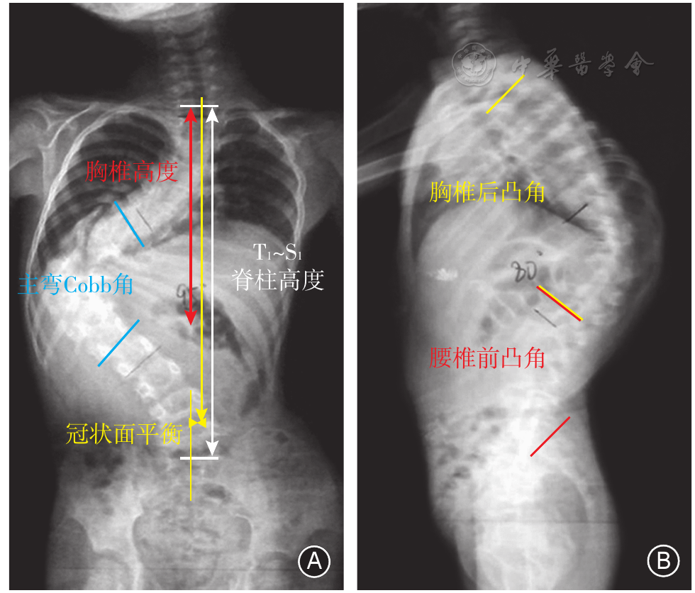 生长撑开型非融合矫形技术治疗早发性脊柱侧凸的远期疗效