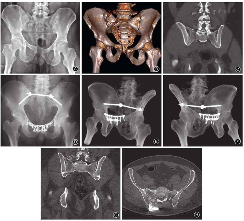 a 术前骨盆正位x线片示右侧骶骨骨折合并前方耻骨联合分离 b 骨盆ct