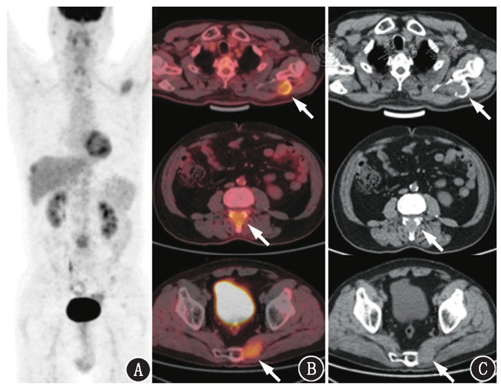 pet/ct融合图像及ct图像见全身骨骼多发代谢增高灶,呈膨胀性生长,伴