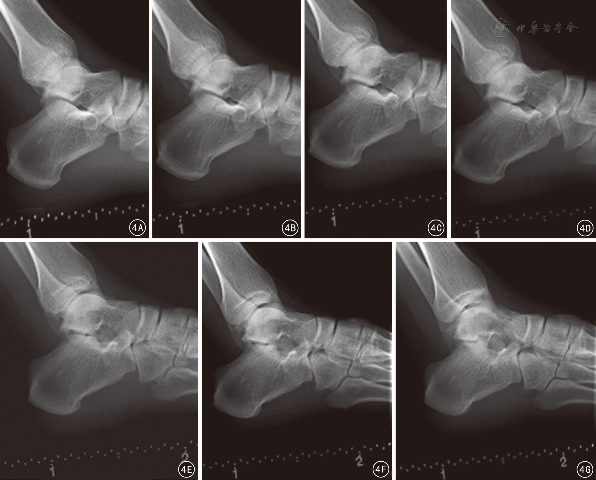 图4 x线球管位于不同角度拍摄足侧位x线片观察距跟骨间韧间隙  4a 尾