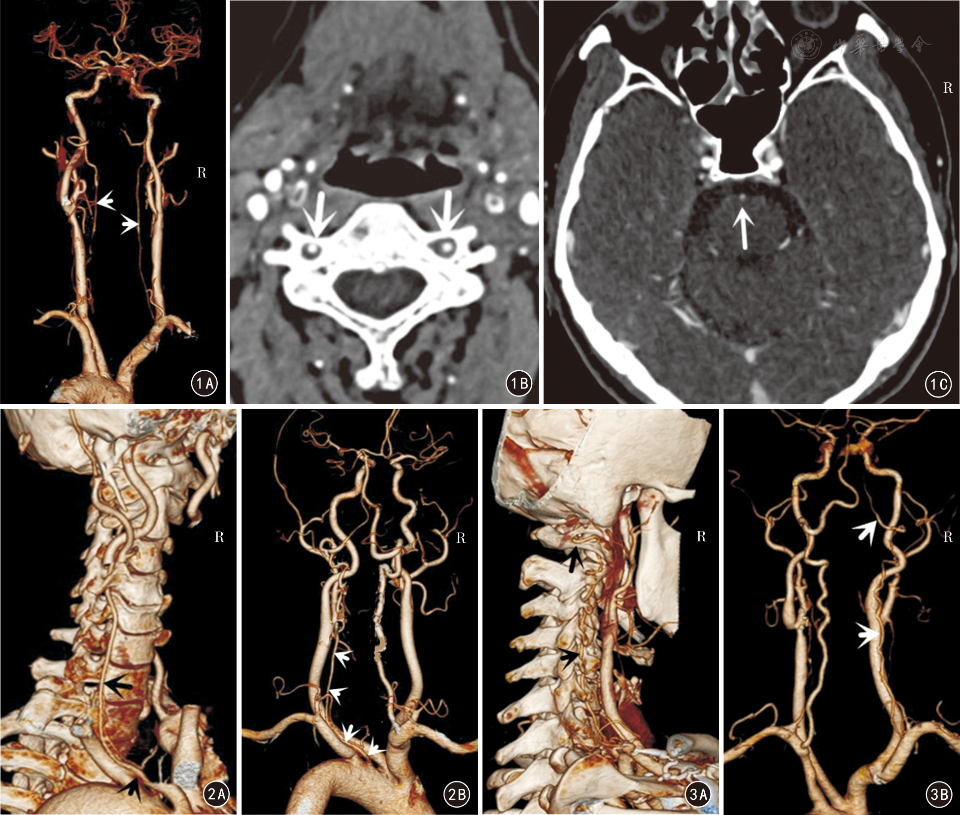 椎动脉多发复合变异的ct血管成像观测及临床意义 中华解剖与临床杂