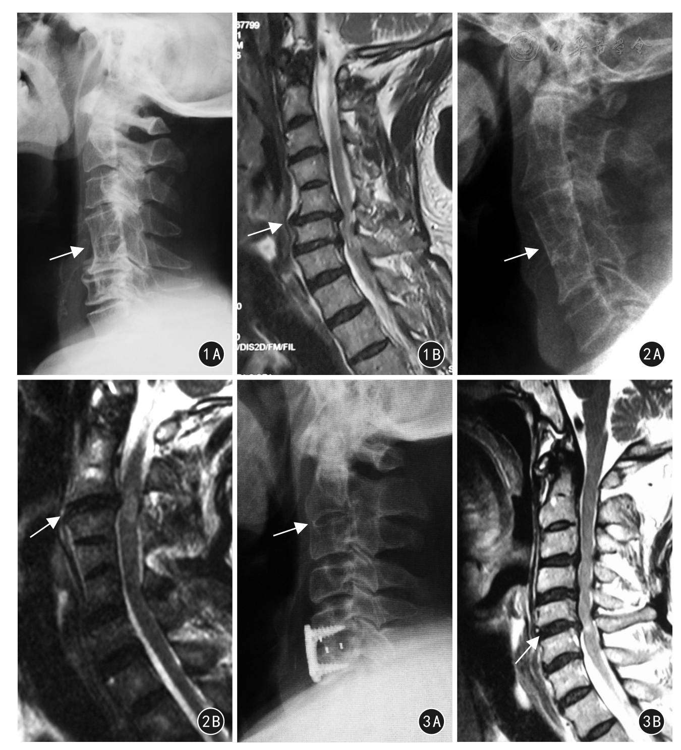 脊髓型颈椎病合并椎体分节不良的临床及影像学的特点分析