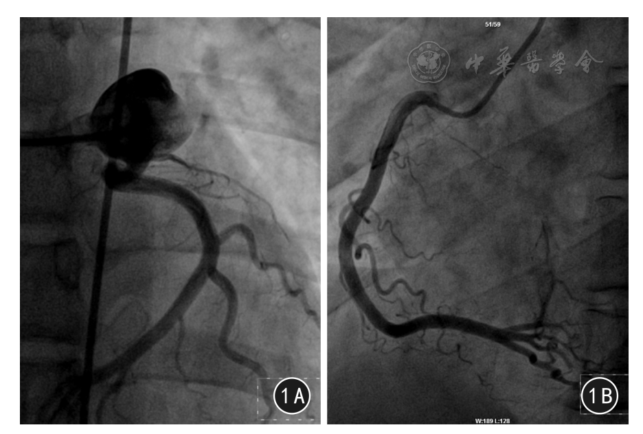左冠状动脉主干巨大动脉瘤并发急性心肌梗死1例