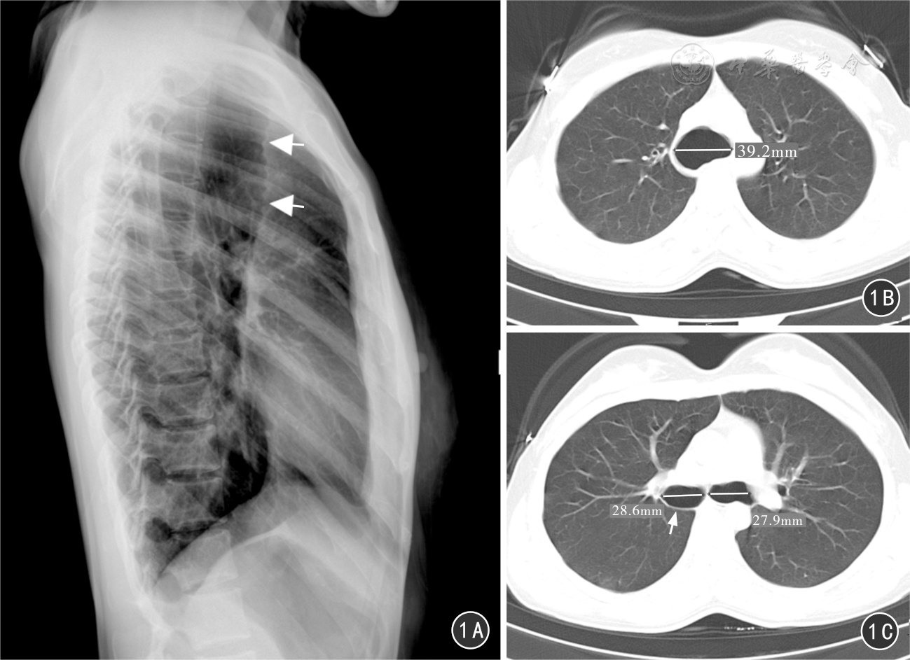 图1 患者女,23岁,4型mounier-kuhn综合征  1a 胸部侧位x线片示气管