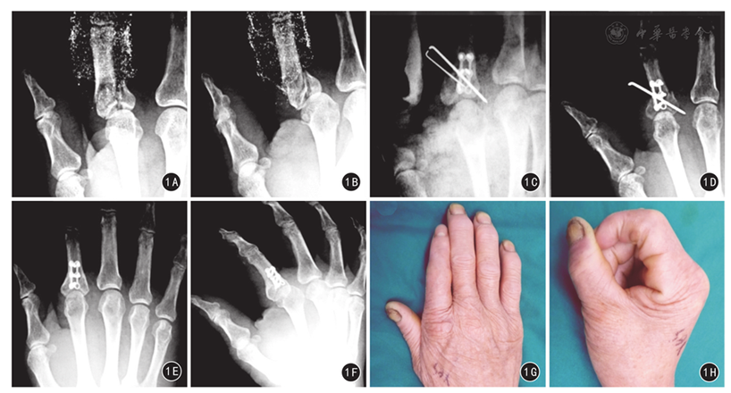 微型钛板螺钉联合克氏针内固定治疗近,中节指骨粉碎性骨折