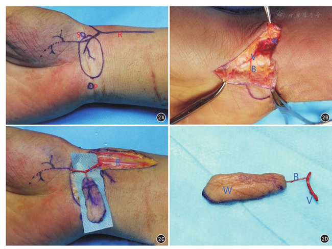 显露桡动脉掌浅支 2c 皮瓣及血管蒂解剖完成 2d 腕横纹皮瓣断蒂形成
