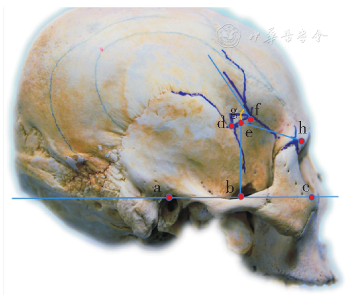 翼点形态特征及其相关径线的应用解剖学观测