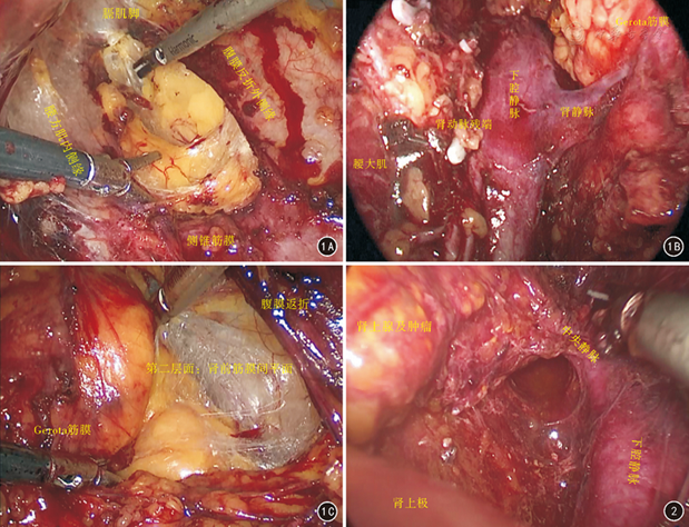 精准解剖性后腹腔镜技术在肾和肾上腺占位性病变中的应用 - 中华解剖