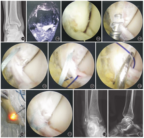 全踝关节镜下距腓前韧带一期修复术治疗新鲜外踝撕脱骨折