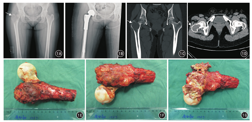 扩大刮除植骨与瘤段切除重建治疗股骨近端骨巨细胞瘤的疗效分析