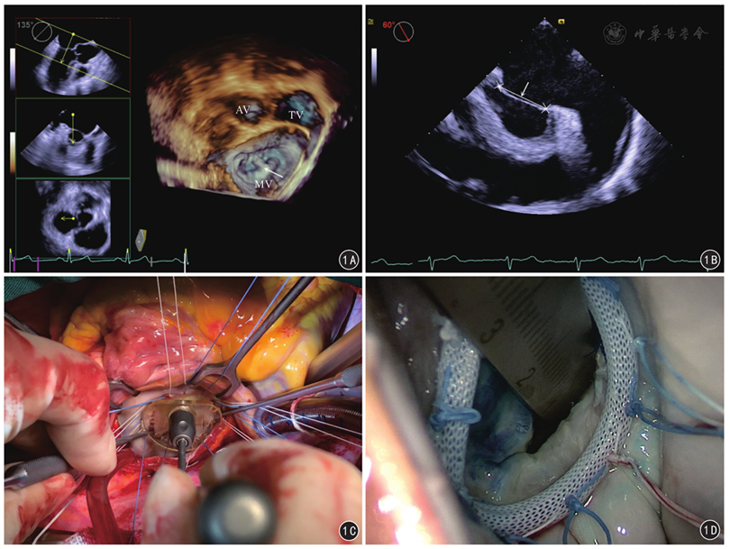 四维经食管超声心动图在二尖瓣成形术中的应用