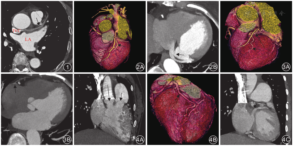 ct横断面图像显示心大静脉(箭)沿左心房(la)前壁走行,直至汇入上腔