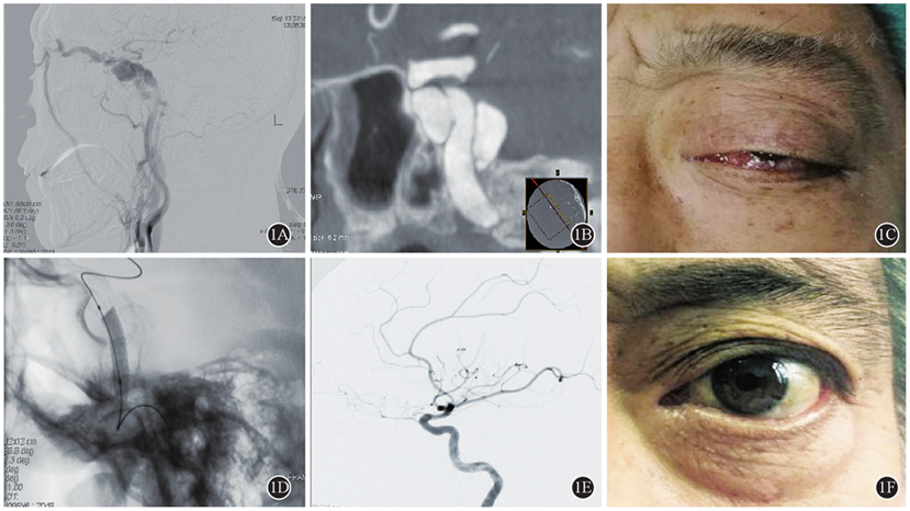 以突眼为表现的眼部血管病—颈动脉海绵窦瘘的介入治疗